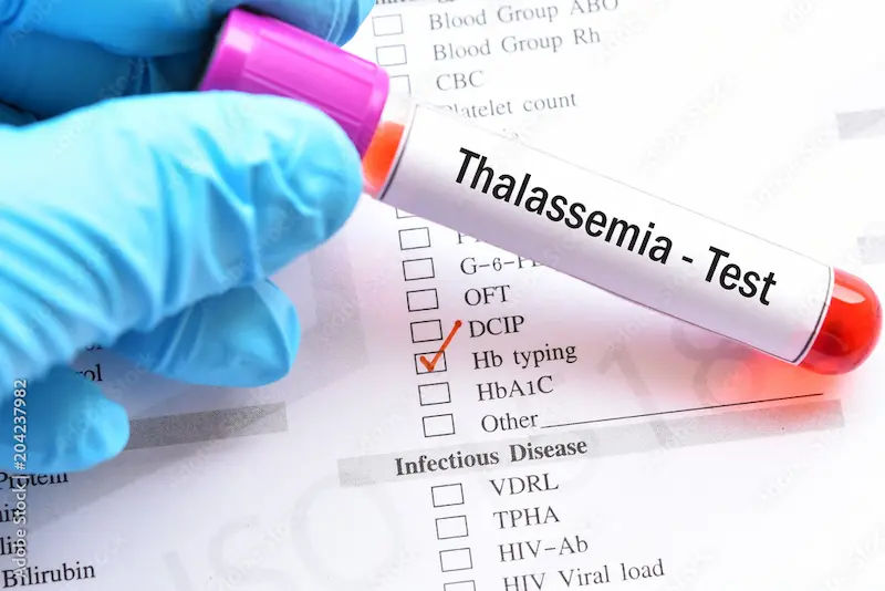 Thalassaemia Screening A Crucial Step Before Marriage & Pregnancy